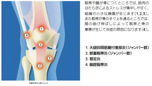 膝周りの慢性障害（ジャンパー膝・鵞足炎・ランナー膝）の痛みが発生する部位の説明図